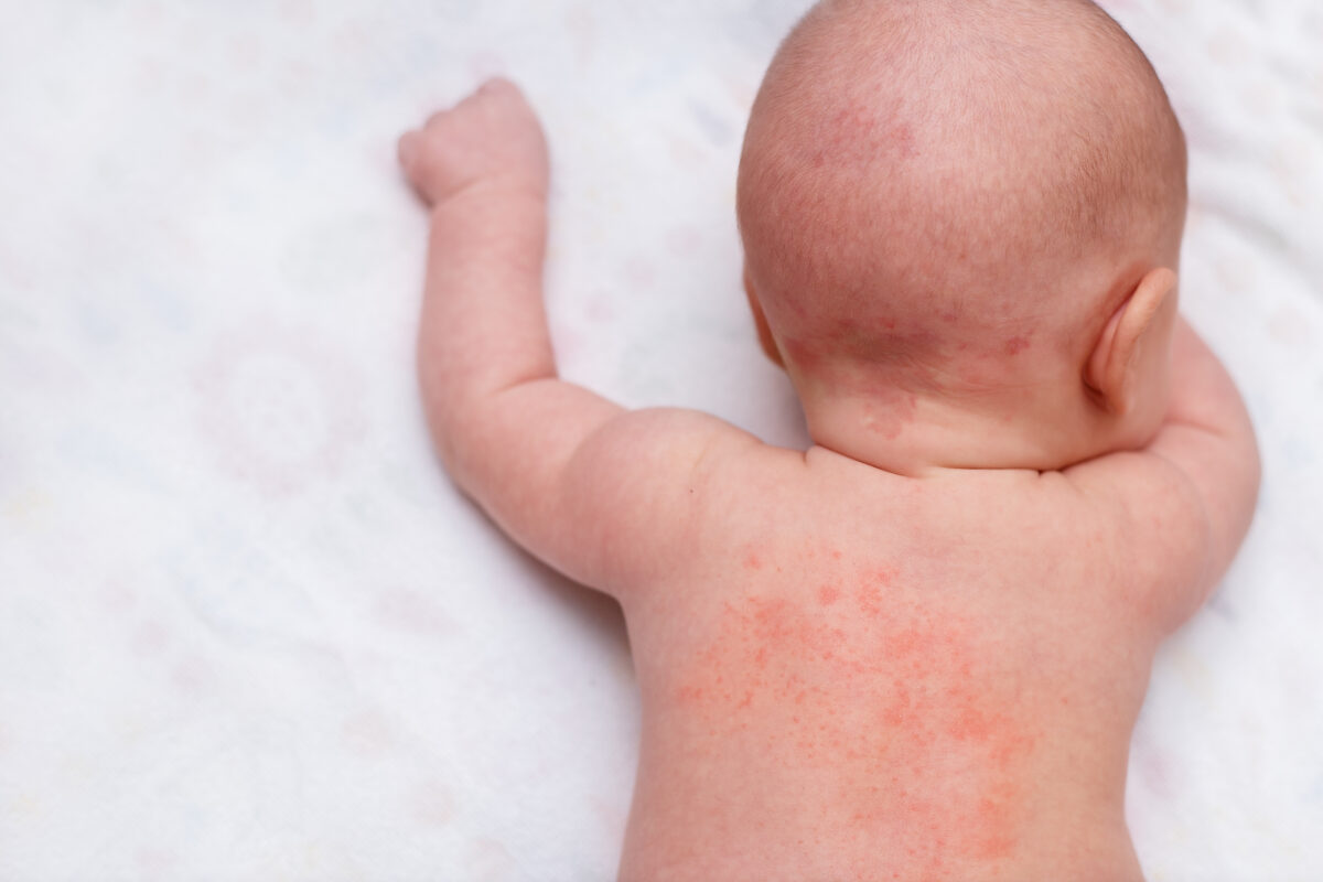 Hoe Kunnen Ouders Allergieën En Huidirritaties Bij Hun Babys Voorkomen Door De Juiste Kleding Te Kiezen?